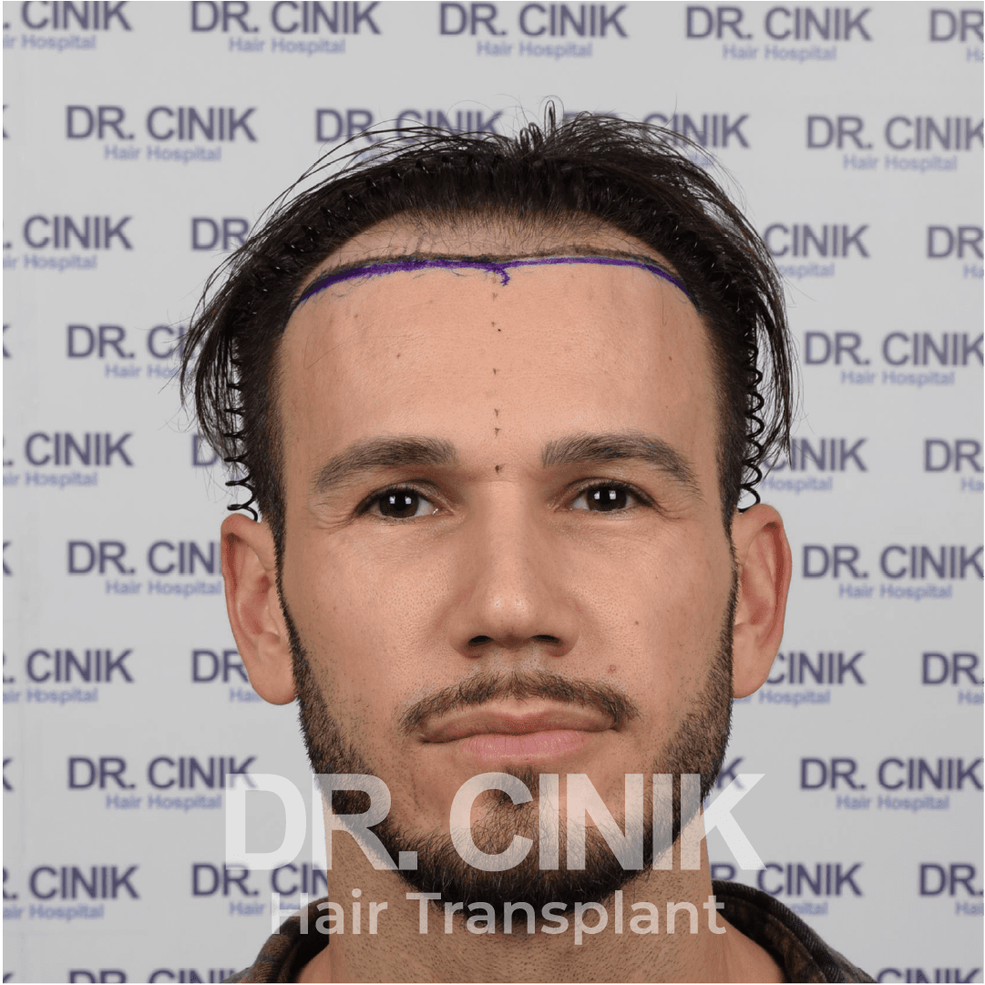 Before – Hair Transplant — Case 7