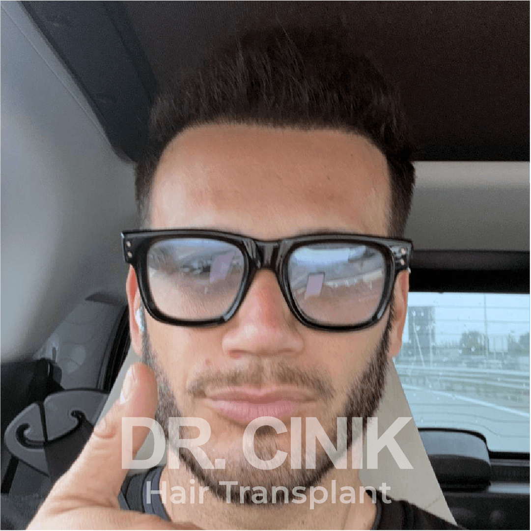 After – Hair Transplant — Case 7