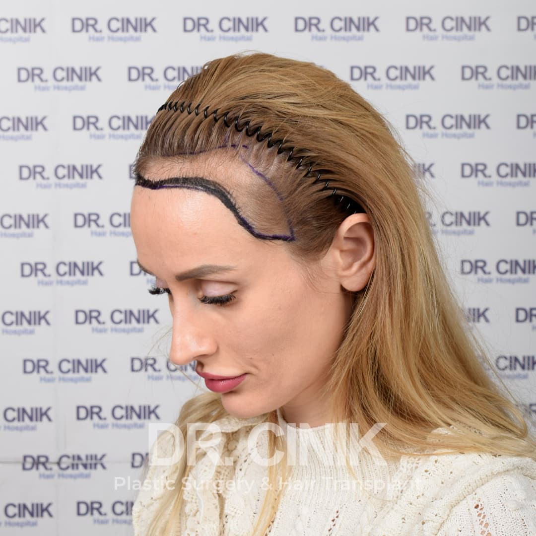 Before – Hair Transplant
