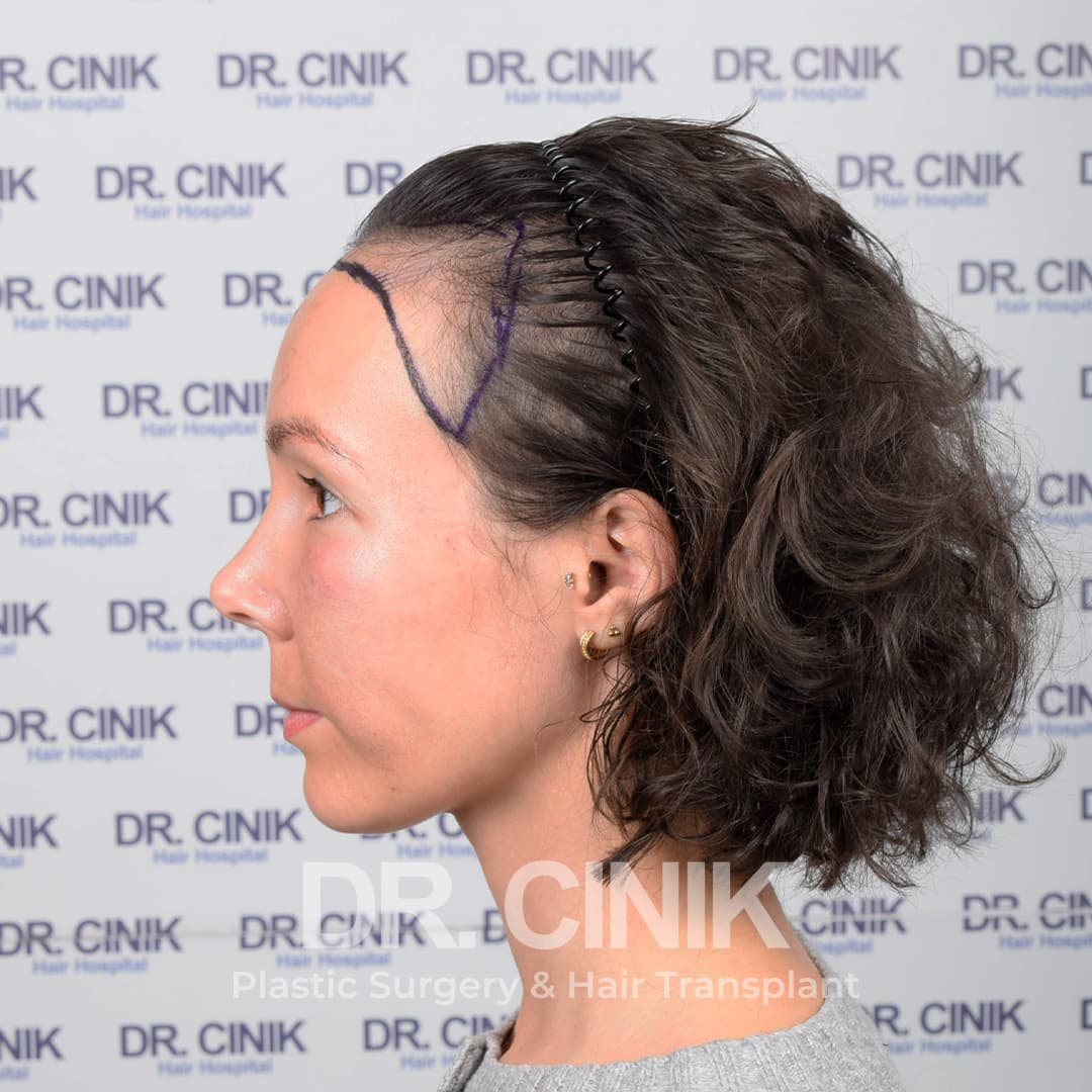 Before – Hair Transplant